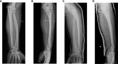 Treatment of delayed union of the forearm with extracorporeal shockwave therapy: a case report and literature review